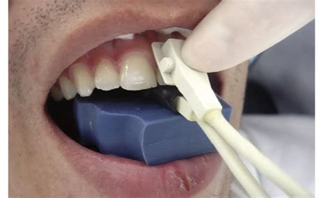 Oxygen saturation testing effective tool to evaluate pulp status of avulsed teeth after ...