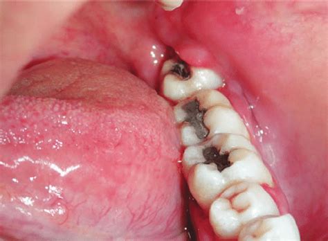 Pericoronal abscess around left mandibular third molar. Mild... | Download Scientific Diagram