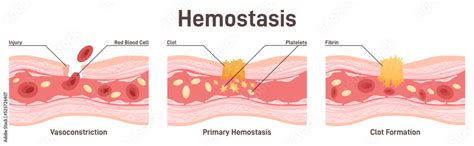 Hemostasis. Wound healing process stages, vasoconstriction and Stock ...