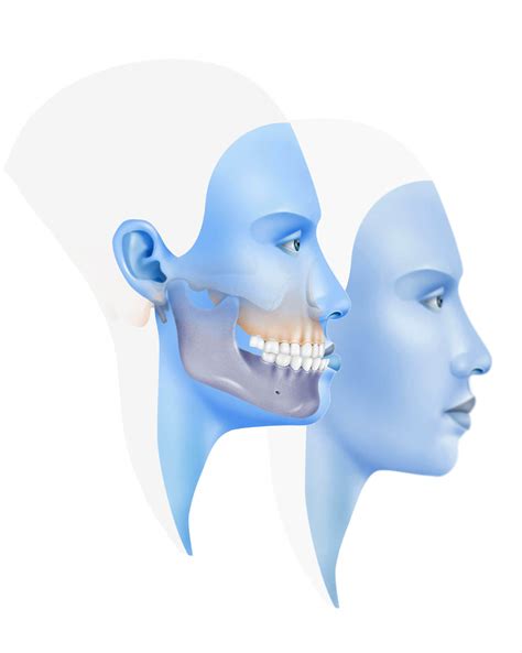 Prognatismo Mandibular o Clase 3 » Cirugía Ortognática - Instituto ...