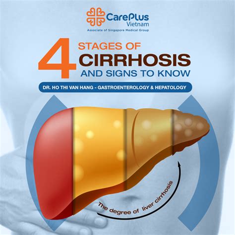 Primary Biliary Cirrhosis Stages Formula