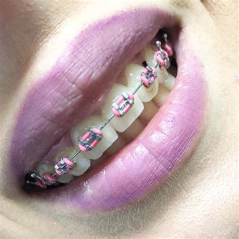 The Best Braces Colors For Girls To Wear | Braces Explained