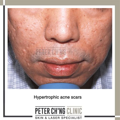 5 Bad Habits That Can Cause Acne Scars | Peter Ch'ng Skin Specialist - KL, Malaysia