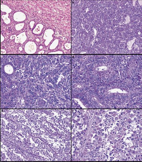 Histological features of acinar cell carcinoma of the liver. (a ...