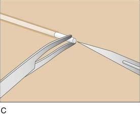 Insertion and Removal of Implanon | Basicmedical Key