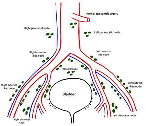 | Anatomy of lymphatic drainage of the bladder. | Download Scientific ...