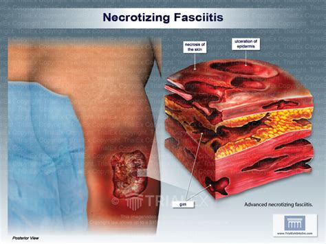 Necrotizing Fasciitis - TrialQuest Inc.