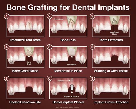 Bone Grafting - Tallahassee and Marianna, FL - Maxillofacial