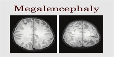 Megalencephaly - Assignment Point