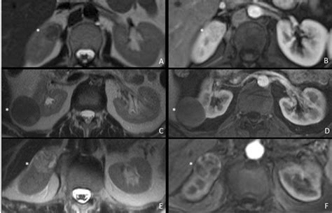 Comparison of renal lipid-poor angiomyolipoma to papillary and clear ...