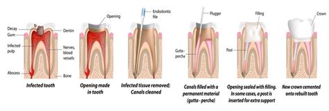 Root Canal Treatment Toorak VIC - Care Family Dental