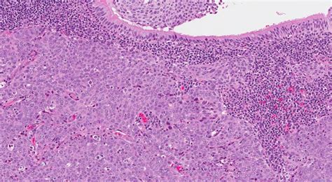 Nasopharyngeal carcinoma | Ottawa Atlas of Pathology