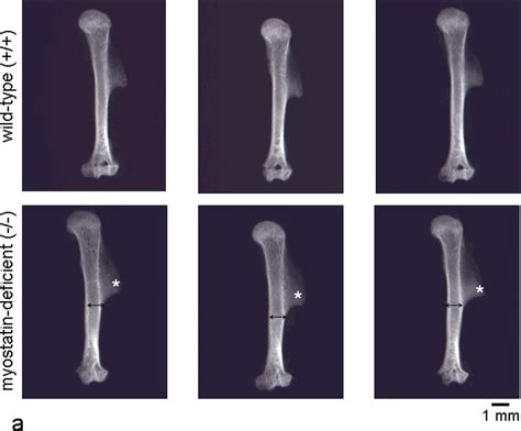 Myostatin Deficiency In Humans