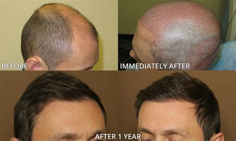 FUE Hair Transplantation – Before and After Pictures * | Dr Turowski - Plastic Surgery Chicago