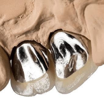 PFM Crown - Full List Of Prices Dental Crowns Mexico - Price Guide 2024