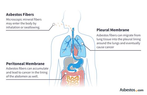 Causes of Mesothelioma: Asbestos Exposure and Risk Factors