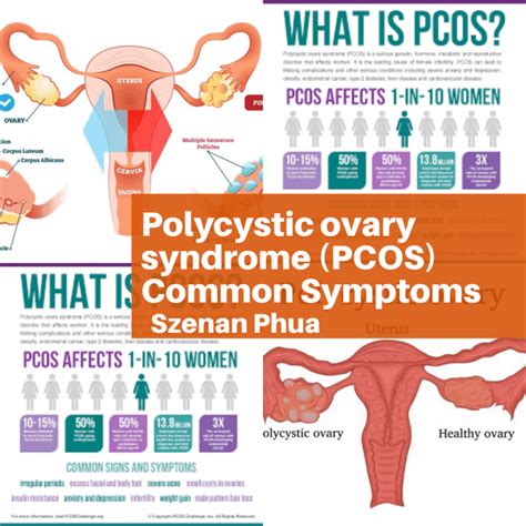 Common Symptoms of PCOS – Best Acupuncture Hamilton NZ