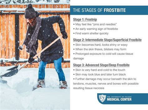 Stages of Frostbite | Frostbite, Warning signs, Signs