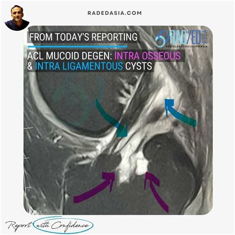 ACL & PCL MUCOID DEGENERATION MRI FINDINGS - Radedasia