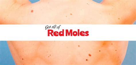 Red Moles On Skin Learn Causes & How to Remove Red Moles