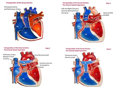 Transposition Of The Great Arteries - Pediatric Heart Specialists