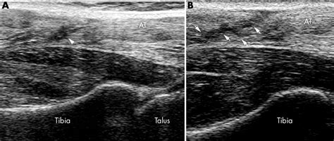 Partial rupture of the proximal Achilles tendon: a differential diagnostic problem in ultrasound ...