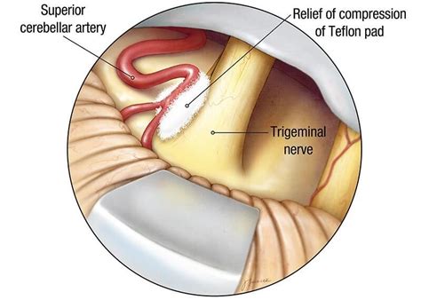 Trigeminal Neuralgia | Symptoms, Causes, Treatment