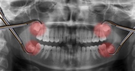 What You Need to Know About Wisdom Teeth Removal