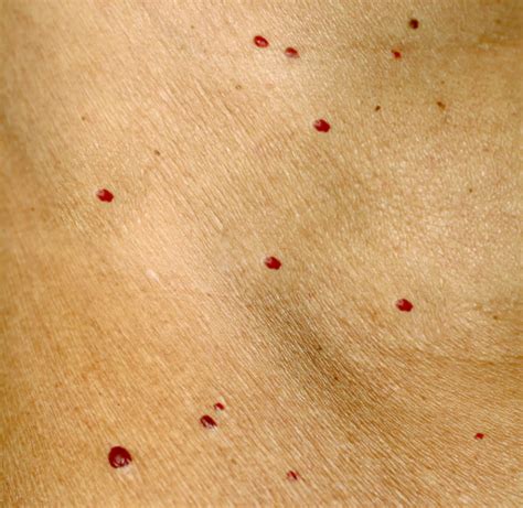 Red Dots Appearing On Skin | Images and Photos finder