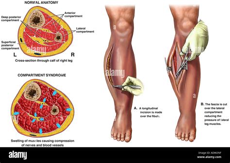 Compartment Syndrome with Fasciotomy Surgery Stock Photo: 7711454 - Alamy