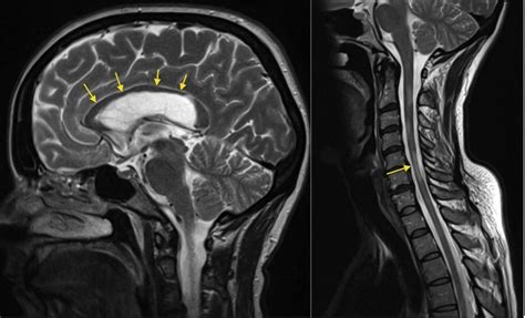 Multiple sclerosis - spinal cord atrophy - Radiology at St. Vincent's University Hospital