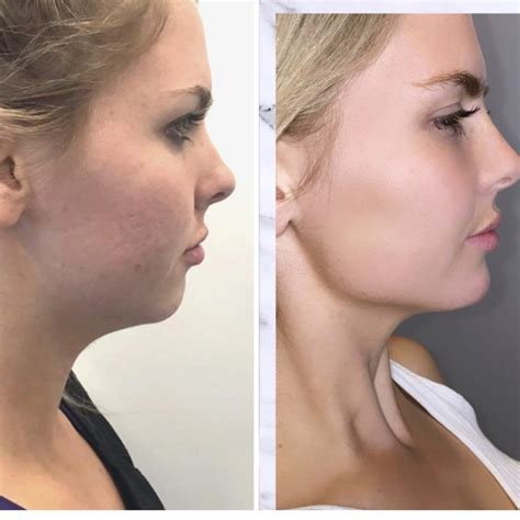 Chin & Jawline Fillers in Gilbert AZ | Colair Med Spa