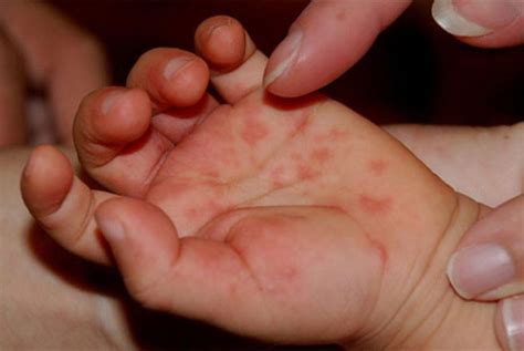 "Massive Outbreak" of Hand, Foot and Mouth Disease in Sydney - Mumslounge