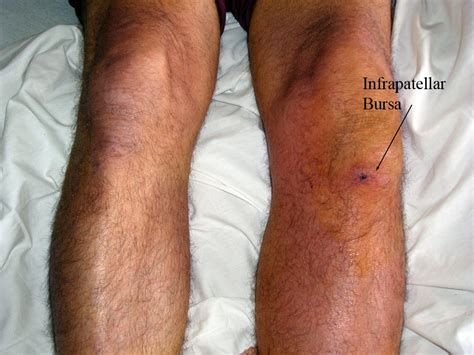 Prepatellar bursitis - wikidoc