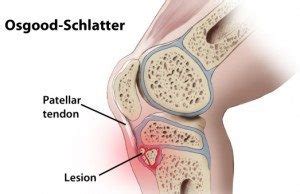 Osgood Schlatter / Sinding Larson Johansson syndroom ⋆ Schrijver Orthopedie B.V.