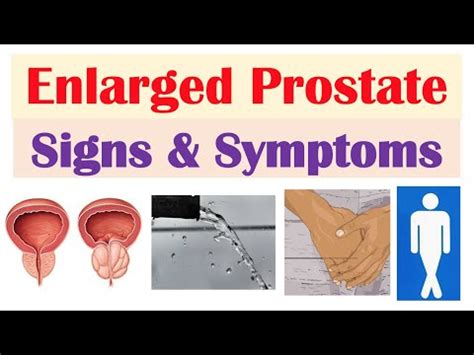 Enlarged Prostate Signs & Symptoms (& Why They Occur) - YouTube