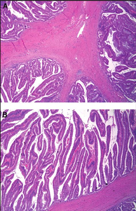 Histologic sections of the (A) tubulovillous adenoma and the (B)... | Download Scientific Diagram