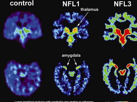 Punch-drunk syndrome: CTE found in former NRL players | The Australian