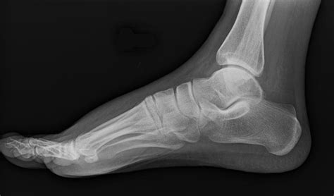 Lateral foot radiograph - Defender of evidence-based medicine