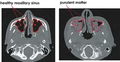 Cross-sectional CT data for maxillary sinuses: left) healthy maxillary... | Download Scientific ...