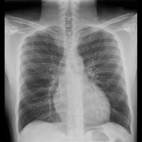 What Does A Bad Chest X Ray Look Like at garyjjacobs blog