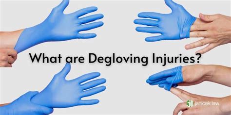 San Antonio Degloving Lawyer | Degloving Injuries San Antonio