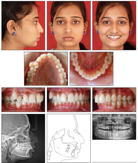 Orthodontic Management of Class II Malocclusion with Unilateral ...