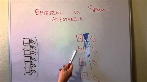 Epidural vs Spinal Anesthesia - YouTube