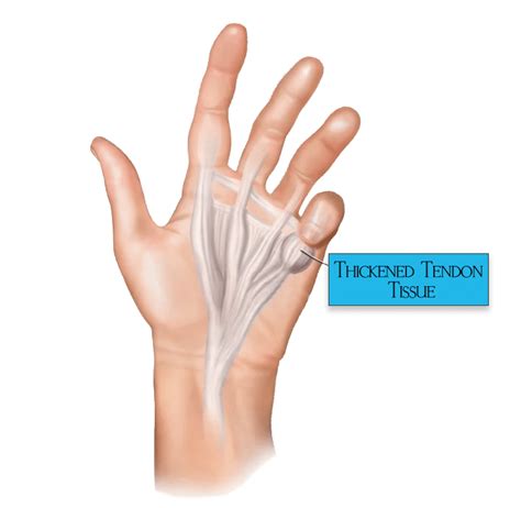 Dupuytren’s Contracture Disease | Florida's #1 Spine & Orthopedic Center