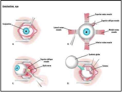 Enucleation, Eye - procedure, recovery, removal, pain, complications ...