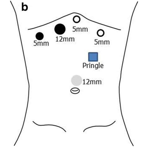 Port placement according the surgical procedure. a Resection of... | Download Scientific Diagram