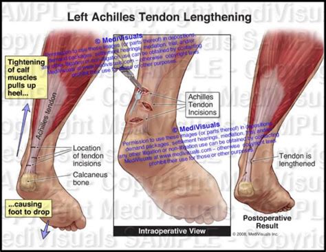 Achilles Tendon Lengthening - Medivisuals Inc.