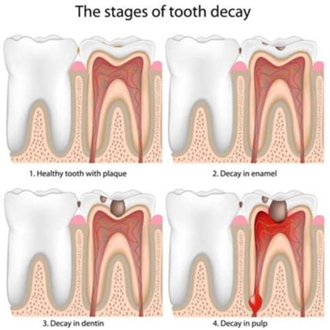 Filling | Dental Filling | Tooth Filling | Dentist