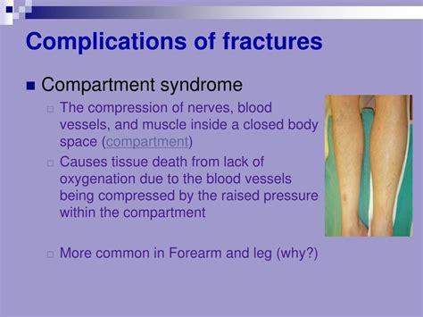 PPT - Bone Fracture and healing PowerPoint Presentation, free download ...